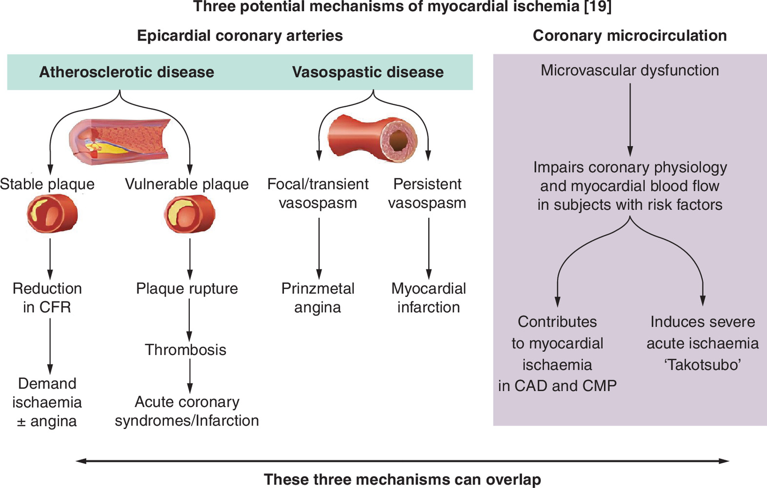 Illustration showing the multifactorial nature of myocardial ischemia, involving coronary microcirculation and endothelial mechanisms.
