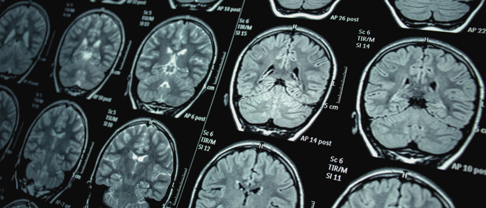 Multiple brain MRI scans display cross-sectional views for neurological analysis.