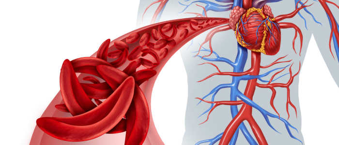 CMS targets sickle cell disease for groundbreaking outcomes-based model ...